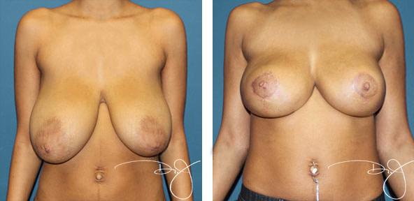 Breast Lift and Breast Reduction