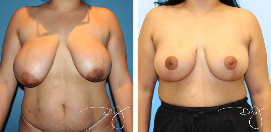 Breast Reduction in Beverly Hills