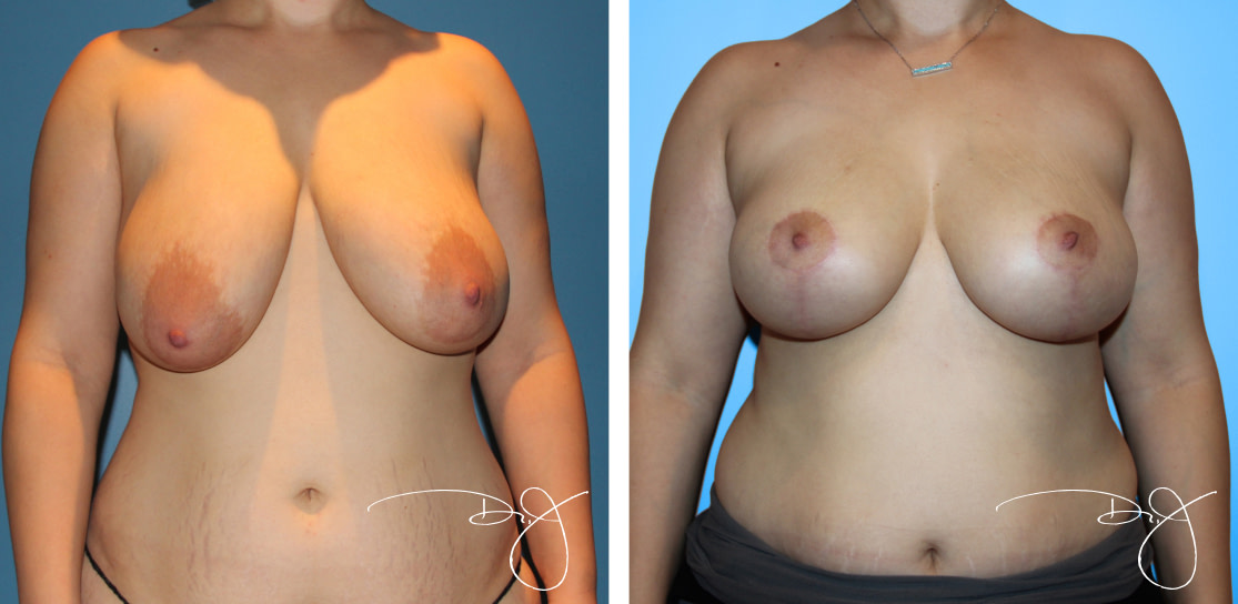 Breast Reduction in Beverly Hills