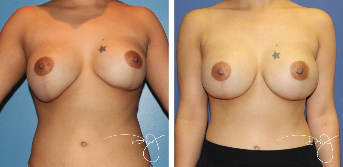 Breast Reconstruction | Beverly Hills