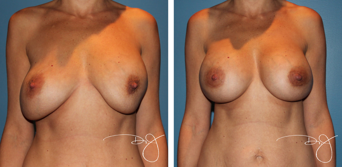 Breast Reconstruction | Beverly Hills