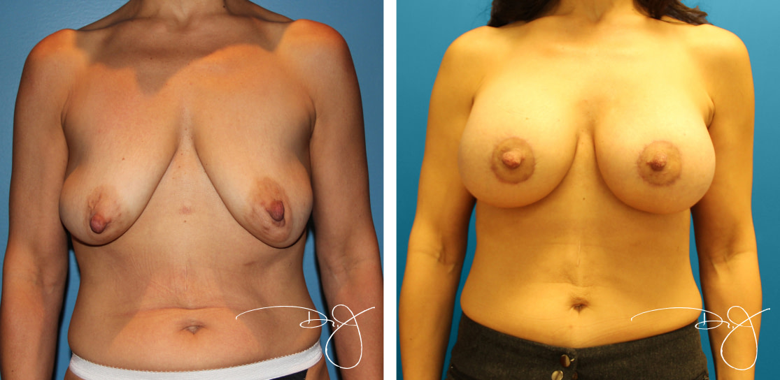 Breast Augmentation with Scarless Breast Lift | Dr. J