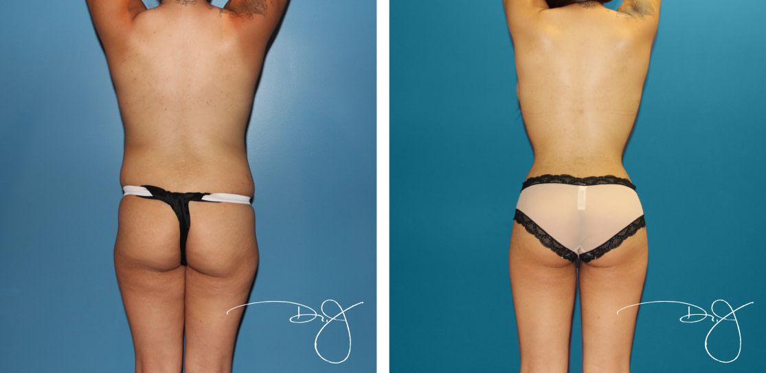 Natural Butt Lift and Breast Augmentation
