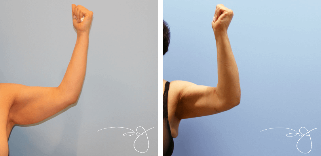 Arm Lift in Beverly Hills | Dr. J Plastic Surgery