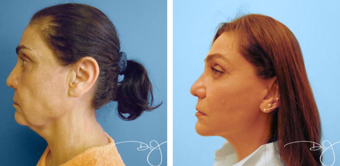 Facial Rejuvenation Before and After