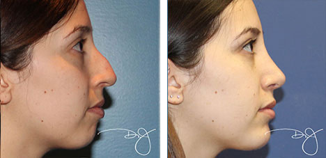 Rhinoplasty and Chin Augmentation Before and After