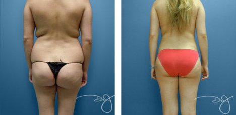Smartlipo Flanks / Love Handles – Patient 2 Before & After Photos (Women)