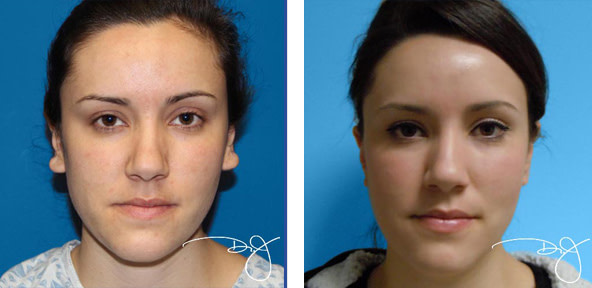 Otoplasty in Beverly Hills | Dr. J Plastic Surgery