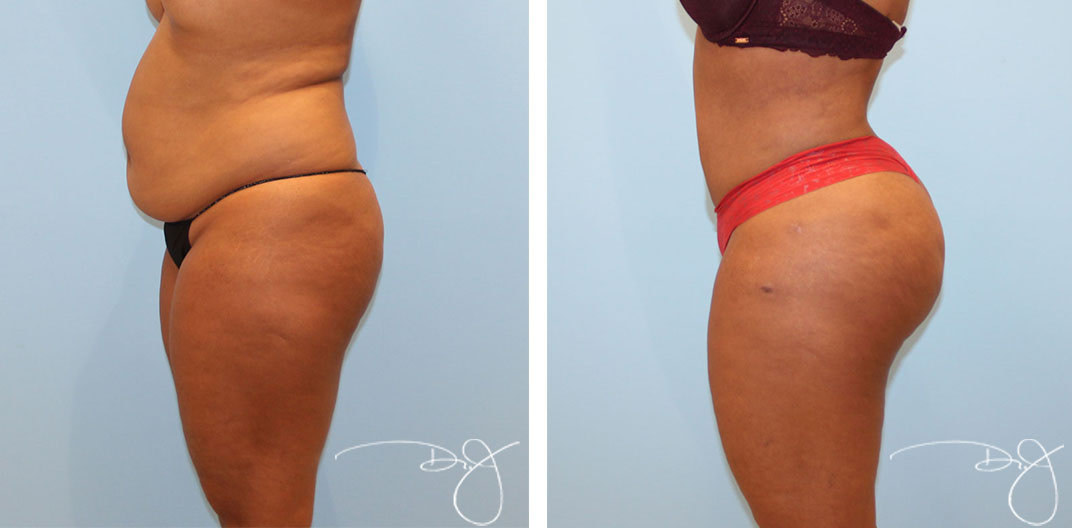 Natural Butt Lift®️ (Buttock Augmentation) Before and After