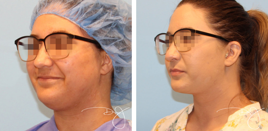 Facial Rejuvenation Before and After