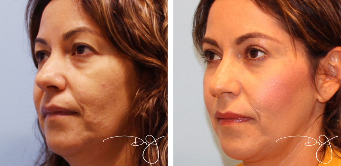 Blepharoplasty Before and After