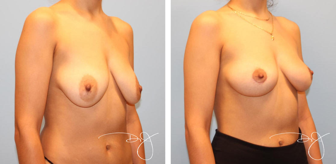 Scarless Breast Lift (No Implants)