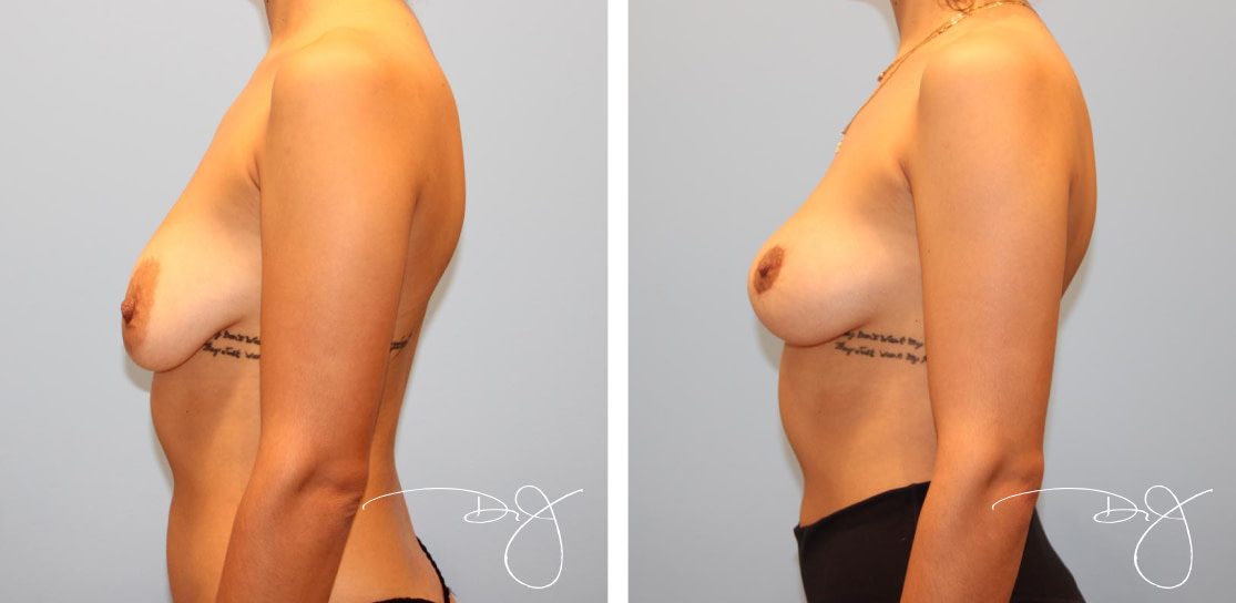 Scarless Breast Lift (No Implants)