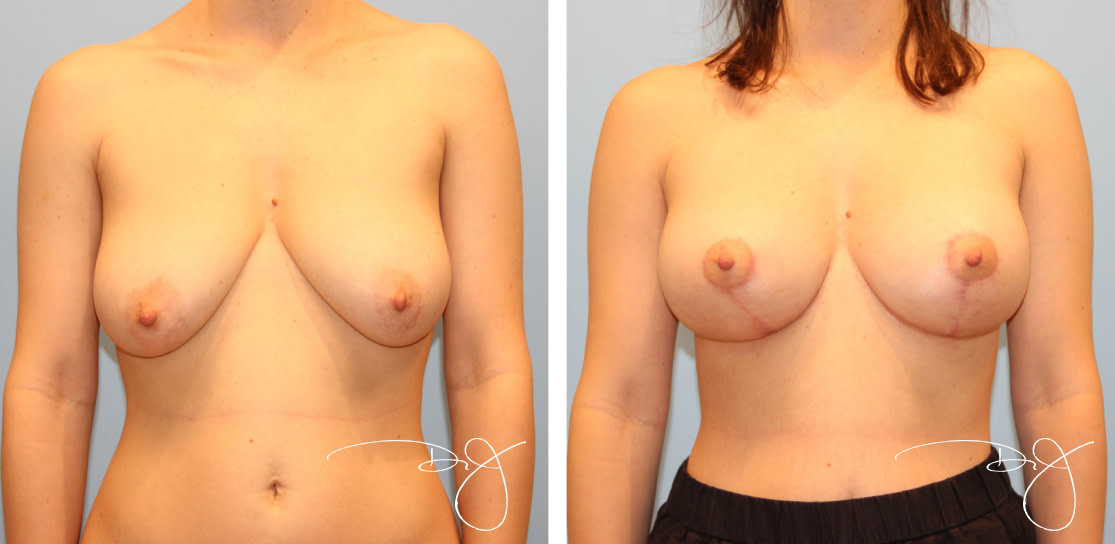 Breast Lift and Breast Reduction