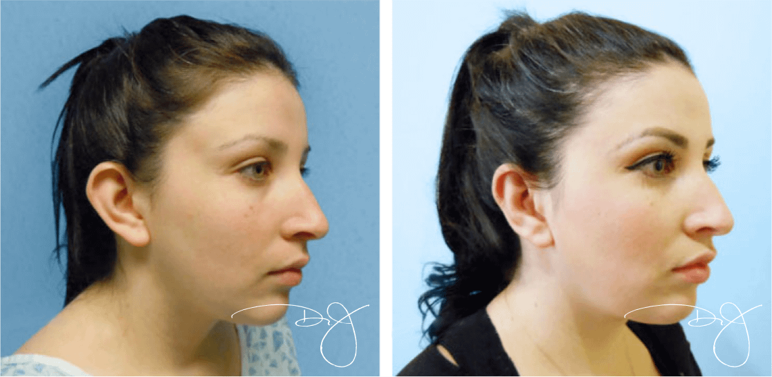 Ear Pinning (Otoplasty) Before and After