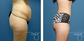 Tummy Tuck Pictures