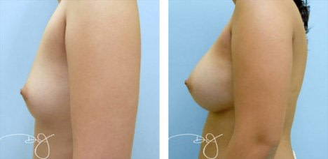Breast Augmentation in L.A., Dr. J