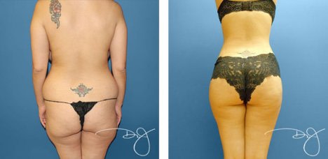 Can Tummy Tuck Surgery Get Rid of My Love Handles?
