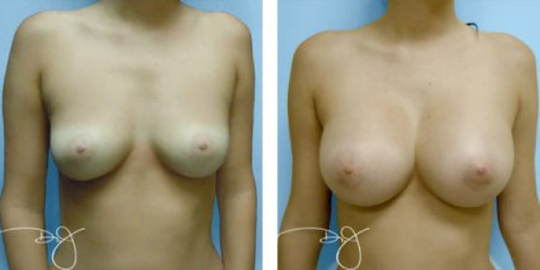 Keep Your Breast Augmentation Cost Low with the Incomparable Dr. J