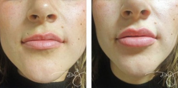 phoca_thumb_l_05-lips-before-after 1
