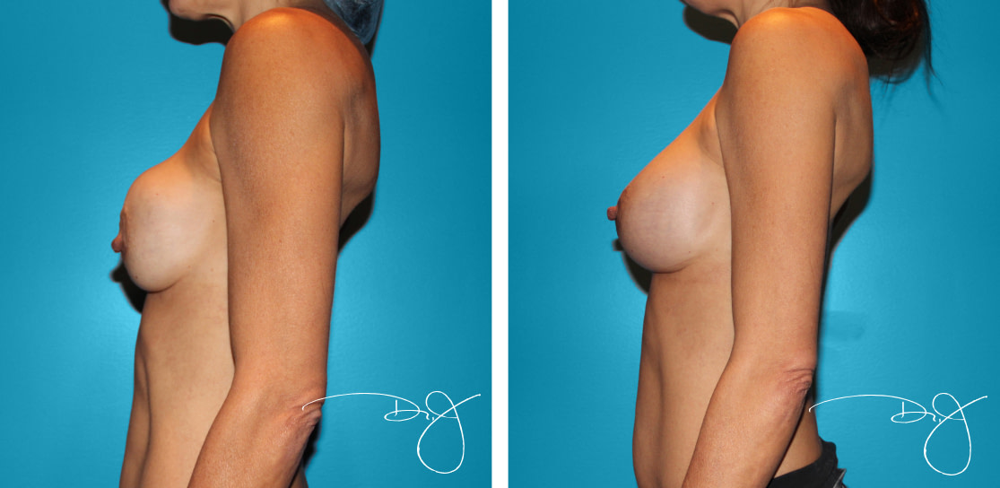 Breast Reconstruction &#038; Revision Before and After
