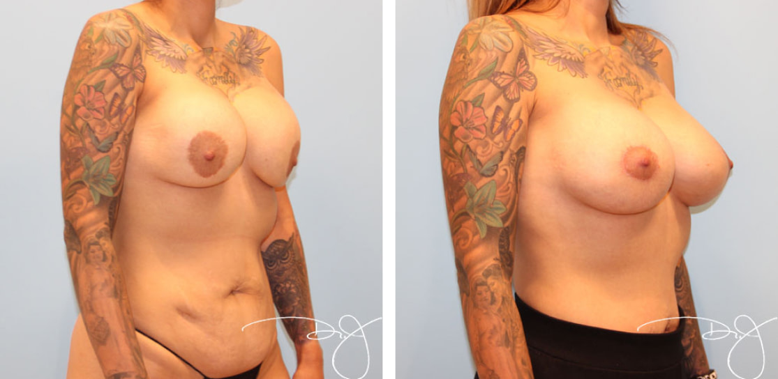 Breast Reconstruction &#038; Revision Before and After