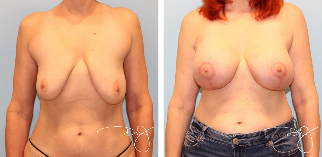 Breast Augmentation with Breast Lift