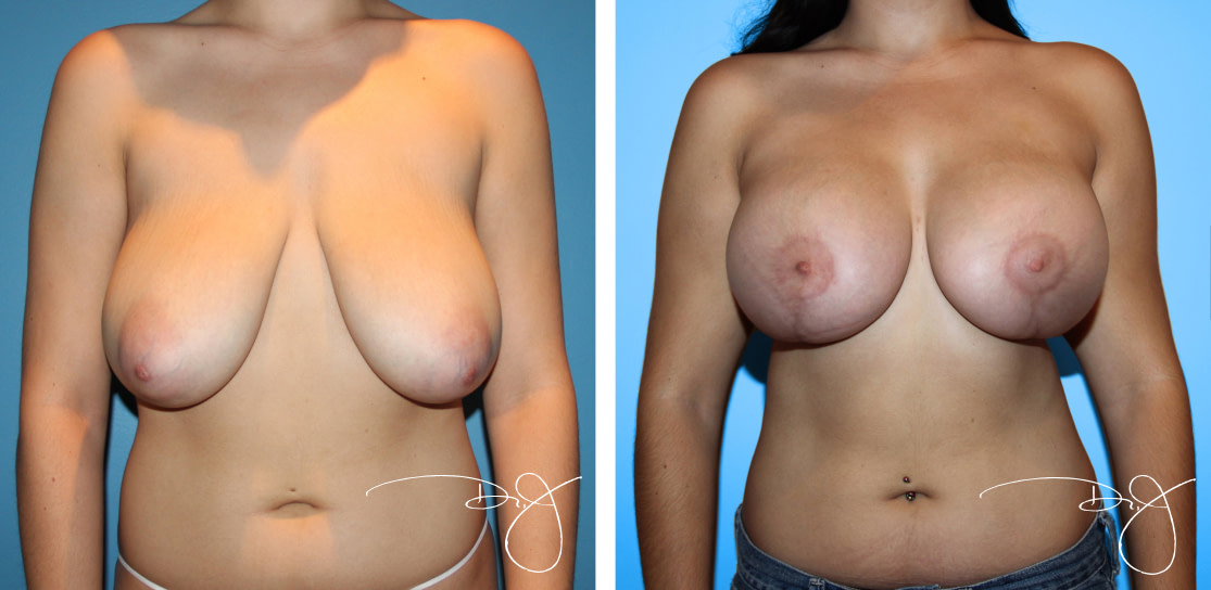 Breast Augmentation with Breast Lift