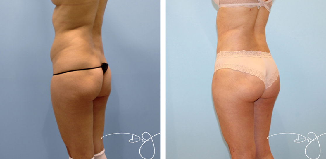Natural Butt Lift®️ (Brazilian Butt Lift) Before and After