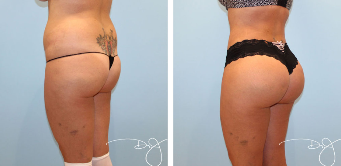Natural Butt Lift®️ (Brazilian Butt Lift) Before and After