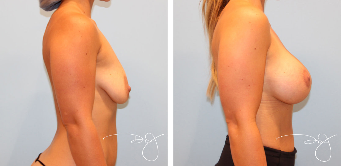 Breast Augmentation with Scarless Breast Lift