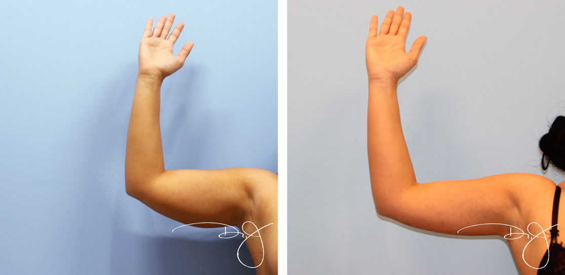 Arm Lift Before and After
