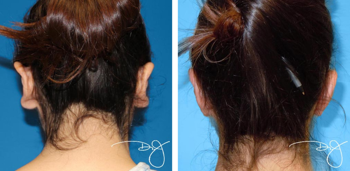 Ear Pinning (Otoplasty) Before and After