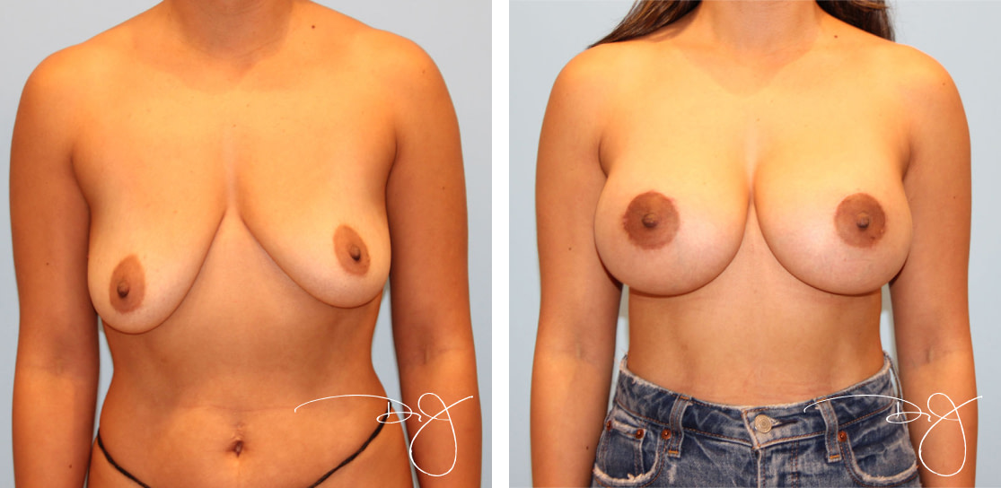 Breast Augmentation with Scarless Breast Lift