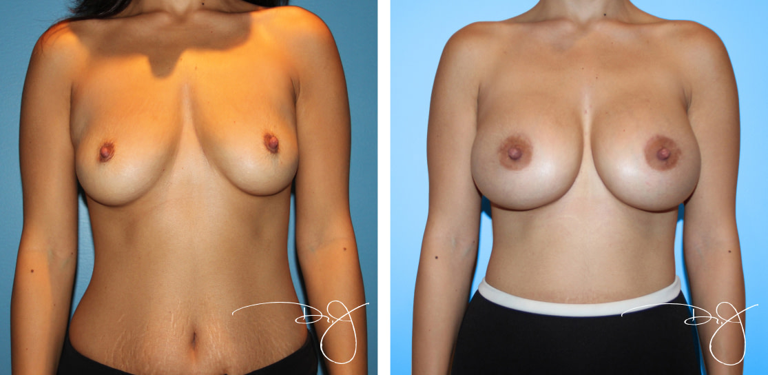 Rapid Recovery Breast Augmentation Beverly Hills