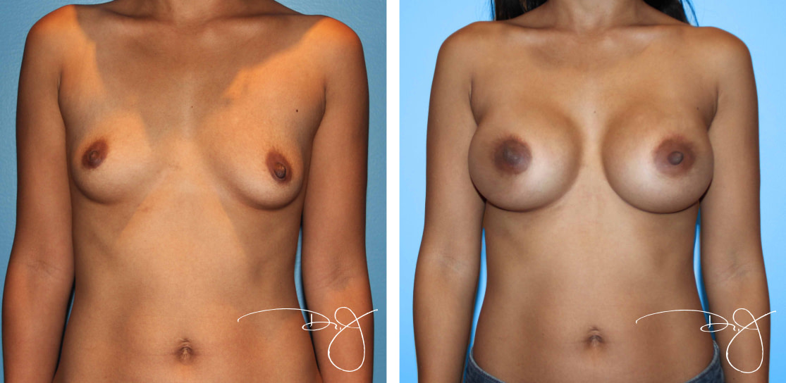 Rapid Recovery Breast Augmentation Beverly Hills
