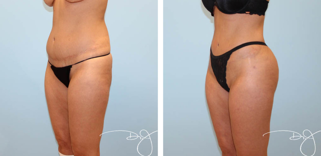 Natural Butt Lift®️ (Buttock Augmentation) Before and After
