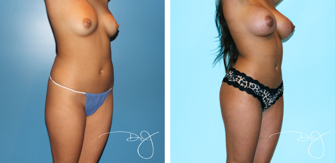 Natural Butt Lift and Breast Augmentation