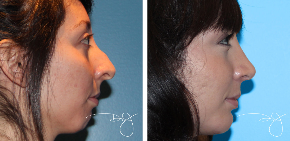 Rhinoplasty and Chin Augmentation Before and After