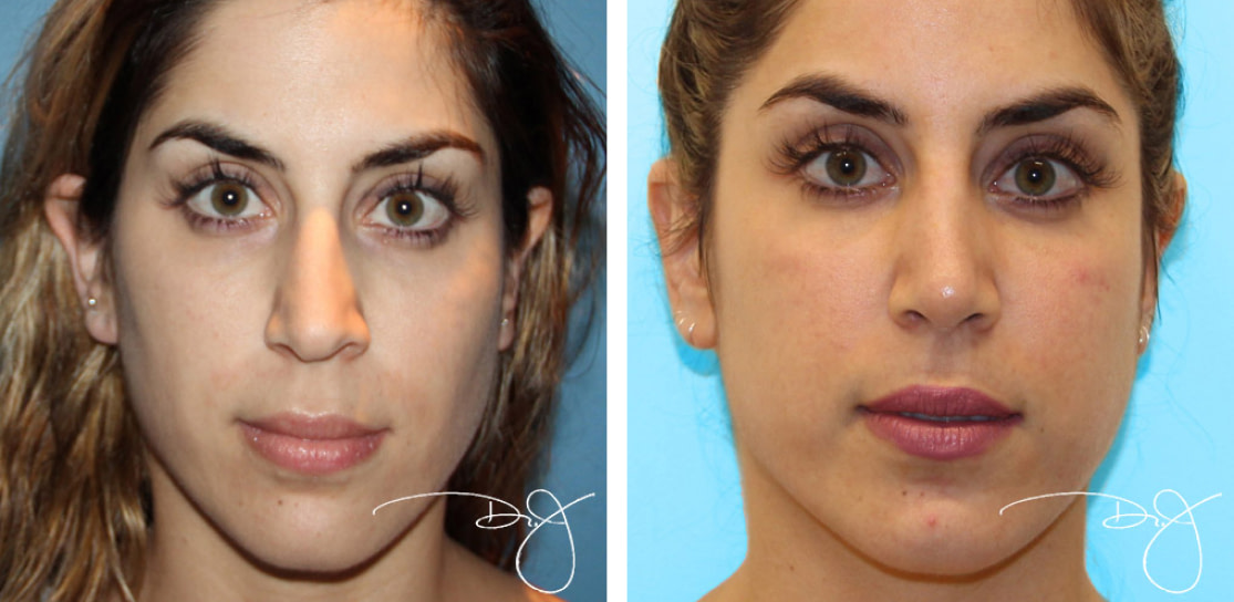 Rhinoplasty in Beverly Hills | Dr. J Plastic Surgery
