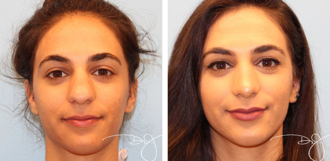 Rhinoplasty in Beverly Hills | Dr. J Plastic Surgery
