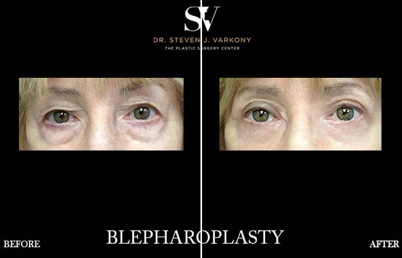upper and lower Blepharoplasty ⁠