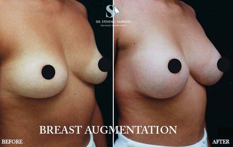 Breast augmentation Encino