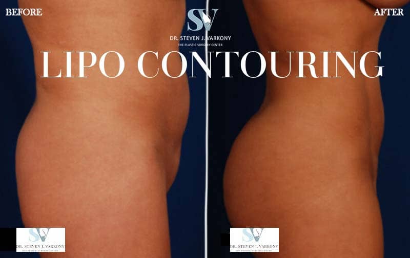 Lipo Contouring before and after