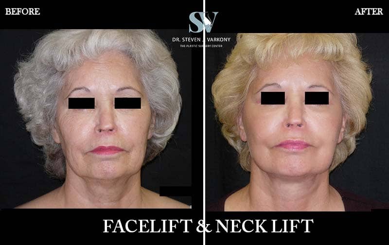 face lift and necklift with platysmaplasty