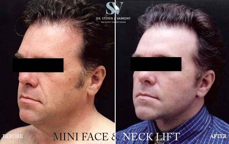 mini FaceLift and Neck lift before and after