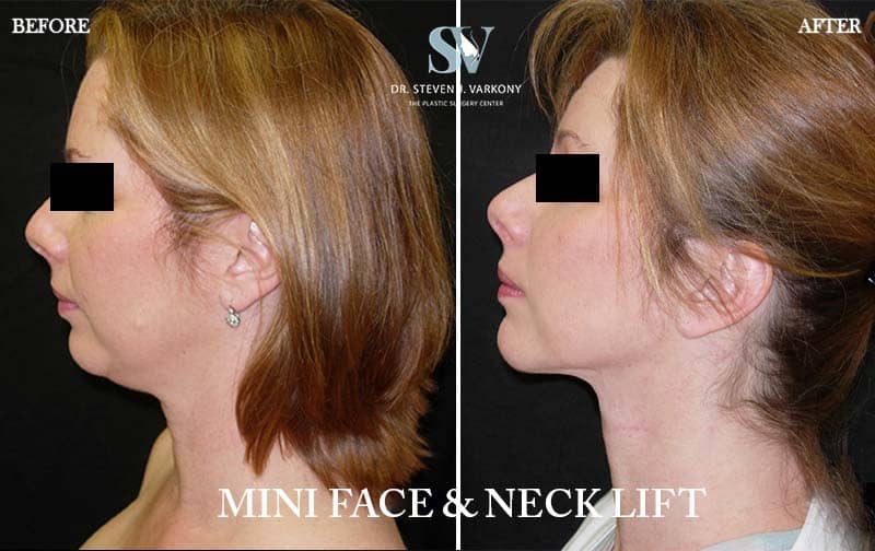mini facelift and neck lift before and after
