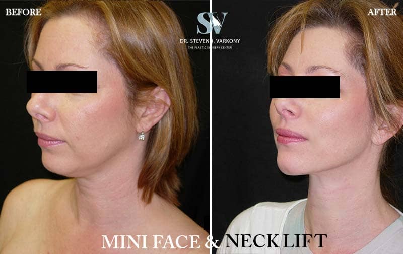 mini face and neck lift before and after