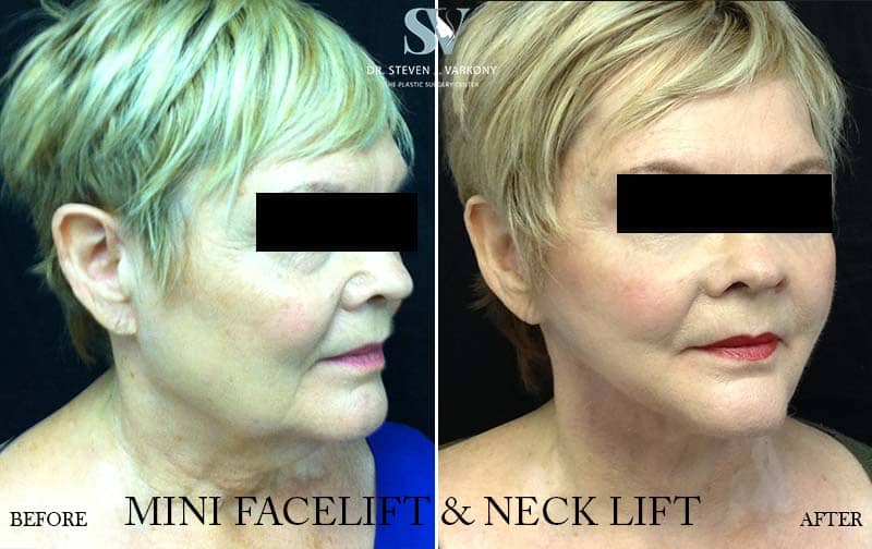 mini face and neck lift with platysmaplasty