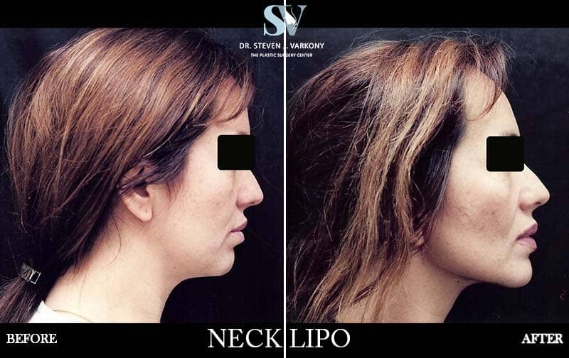 neck liposuction before and after